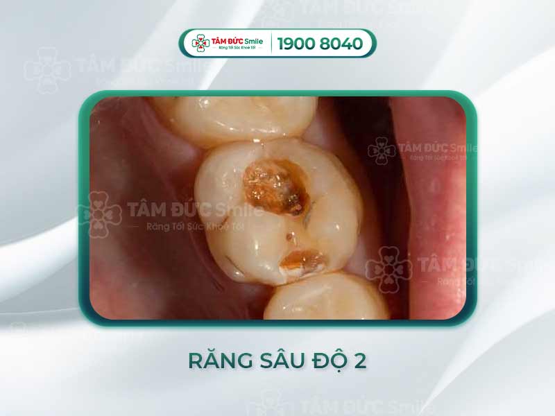 RĂNG SÂU ĐỘ 2 LÀ NHƯ THẾ NÀO?