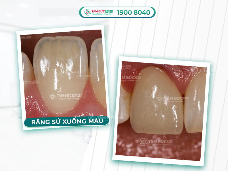 RĂNG SỨ CÓ BỊ XUỐNG MÀU HAY KHÔNG?