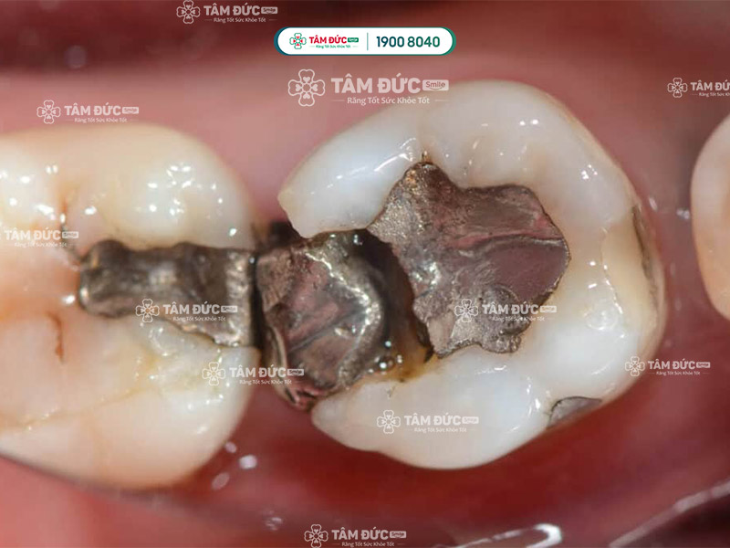 răng trám bị bể làm ảnh hưởng đến sức khoẻ của răng