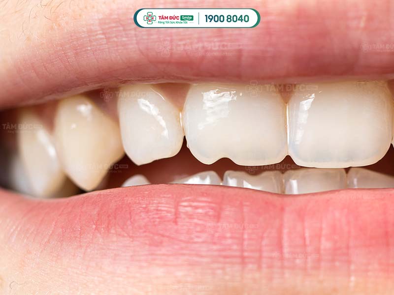 Răng trám bị mẻ gây mất thẩm mỹ, đau nhức