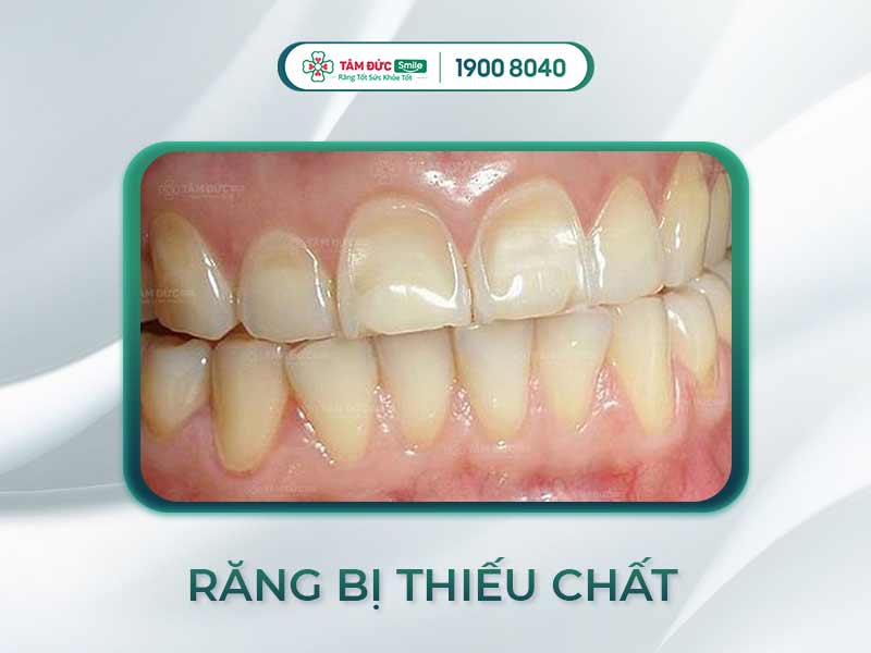 RĂNG YẾU LÀ THIẾU CHẤT GÌ? 11 LOẠI THỰC PHẨM GIÚP RĂNG LUÔN CHẮC KHỎE