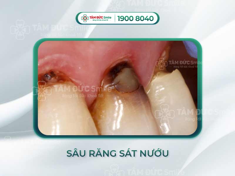 SÂU RĂNG SÁT NƯỚU NHỔ BỎ CÓ ĐAU KHÔNG? GIẢI PHÁP CHỮA TRỊ SÂU RĂNG SÁT NƯỚU