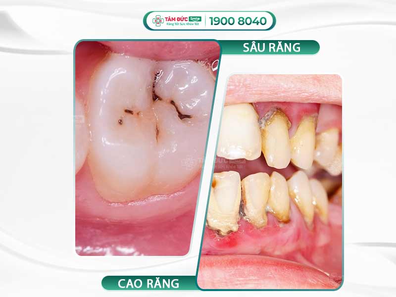 SƯNG NƯỚU RĂNG HÀM TRÊN CÓ MỦ: NGUYÊN NHÂN VÀ CÁCH ĐIỀU TRỊ