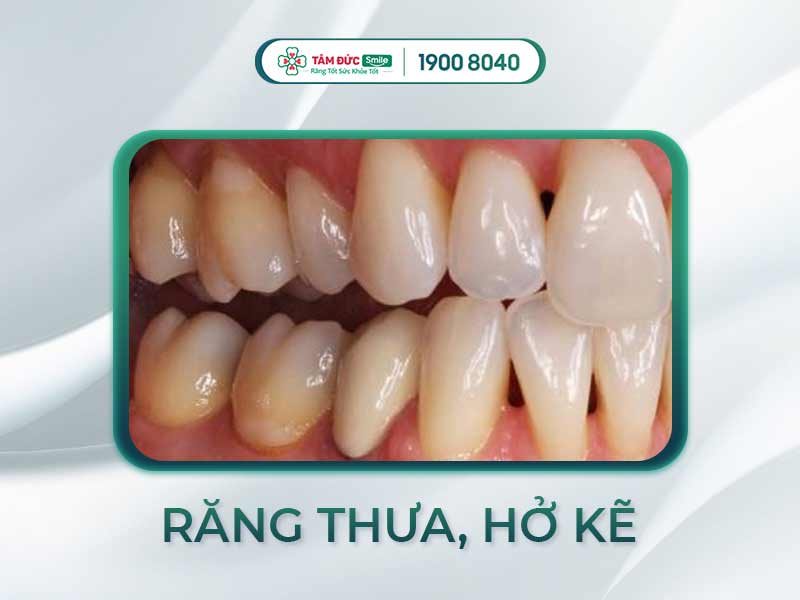 7 TÁC HẠI KHI DÙNG TĂM XỈA RĂNG CẦN PHẢI HẠN CHẾ NGAY