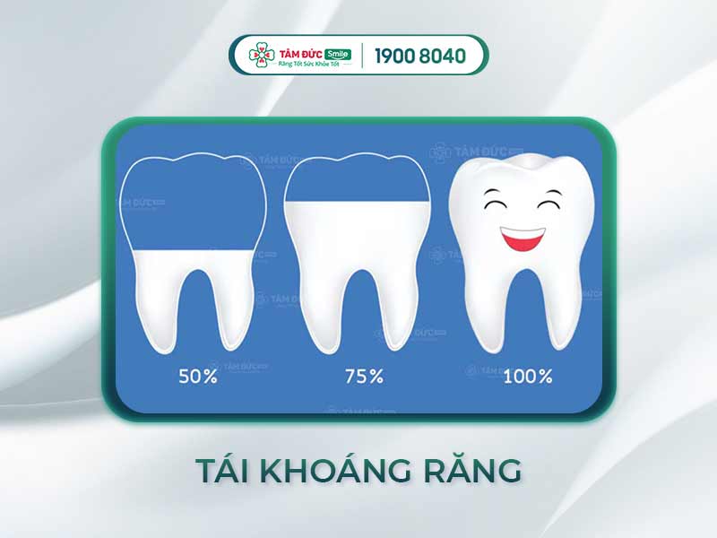 TÁI KHOÁNG RĂNG LÀ GÌ? NHỮNG ĐIỀU NÊN BIẾT VỀ TÁI KHOÁNG RĂNG