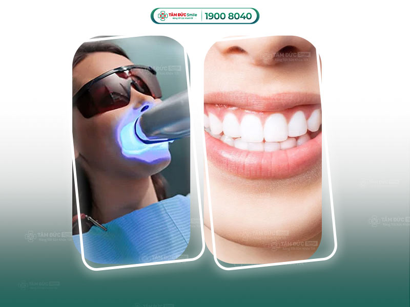 TẨY TRẮNG RĂNG BẰNG ĐÈN PLASMA CÓ THỰC SỰ TỐT KHÔNG?