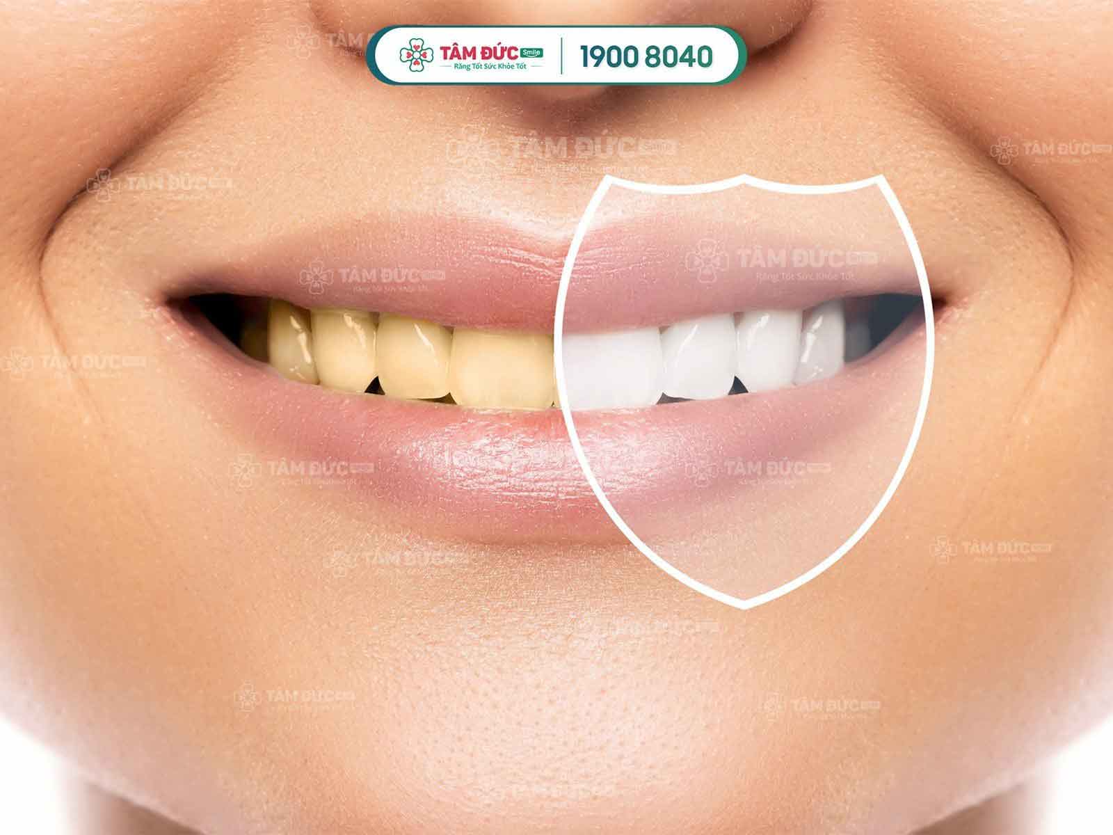 tẩy trắng răng bằng đèn plasma