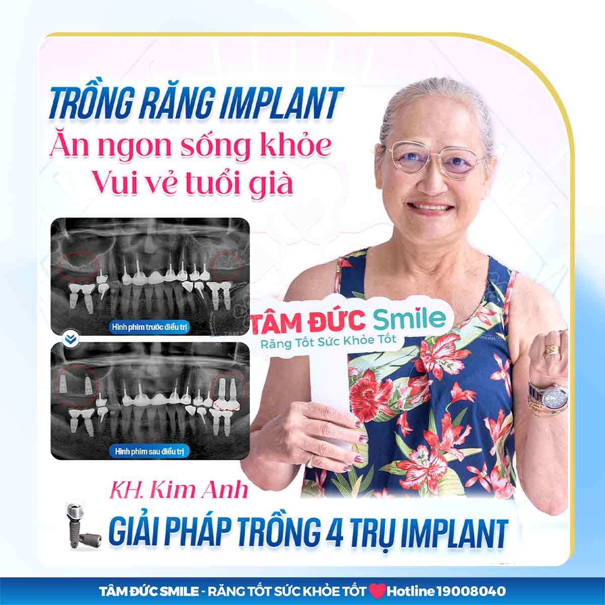 TÔI 52 TUỔI MẤT NHIỀU RĂNG CÓ CẤY GHÉP IMPLANT ĐƯỢC HAY KHÔNG?
