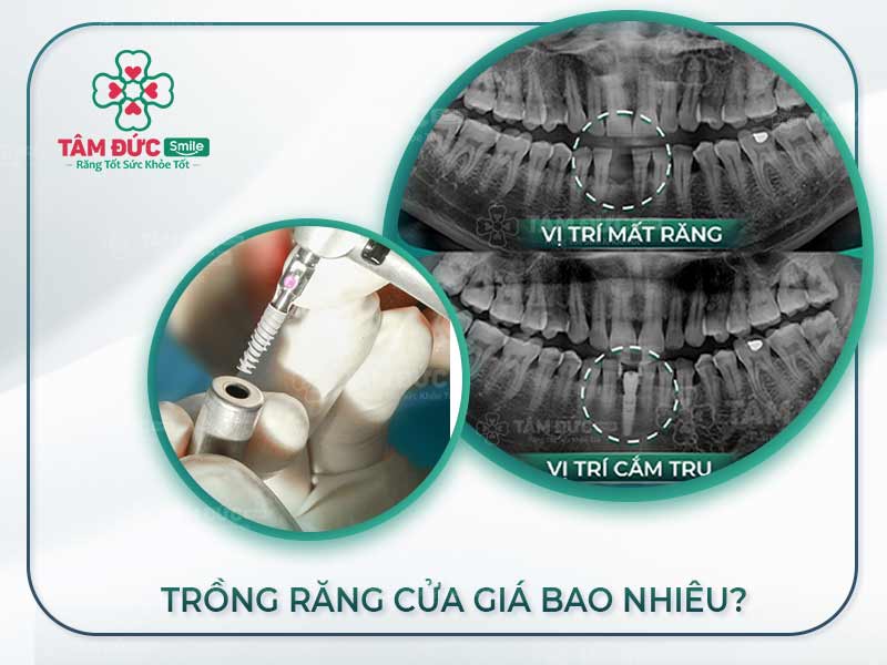 TRỒNG RĂNG CỬA GIÁ BAO NHIÊU? BẢNG GIÁ TẠI NHA KHOA