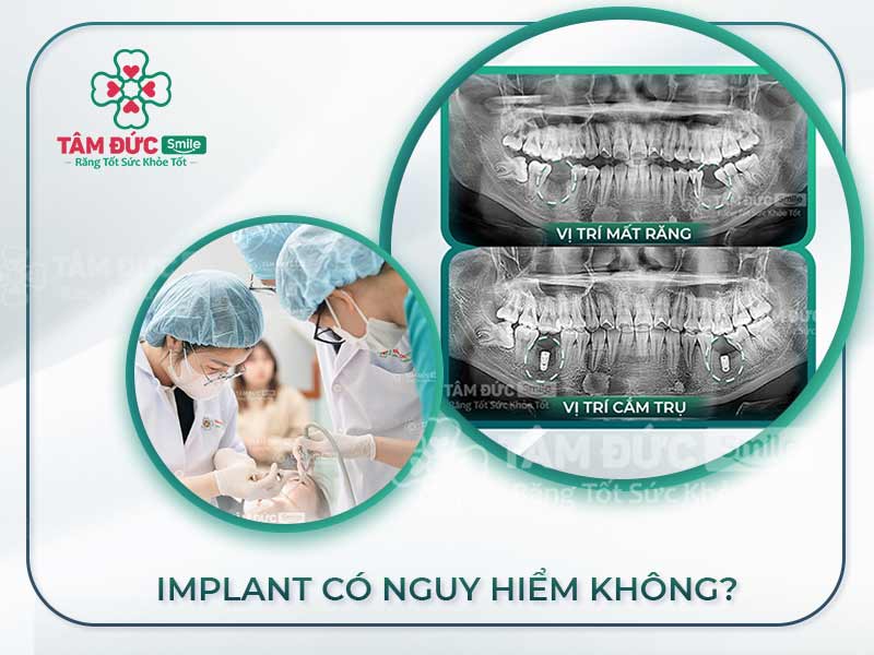 TRỒNG RĂNG IMPLANT CÓ NGUY HIỂM KHÔNG?