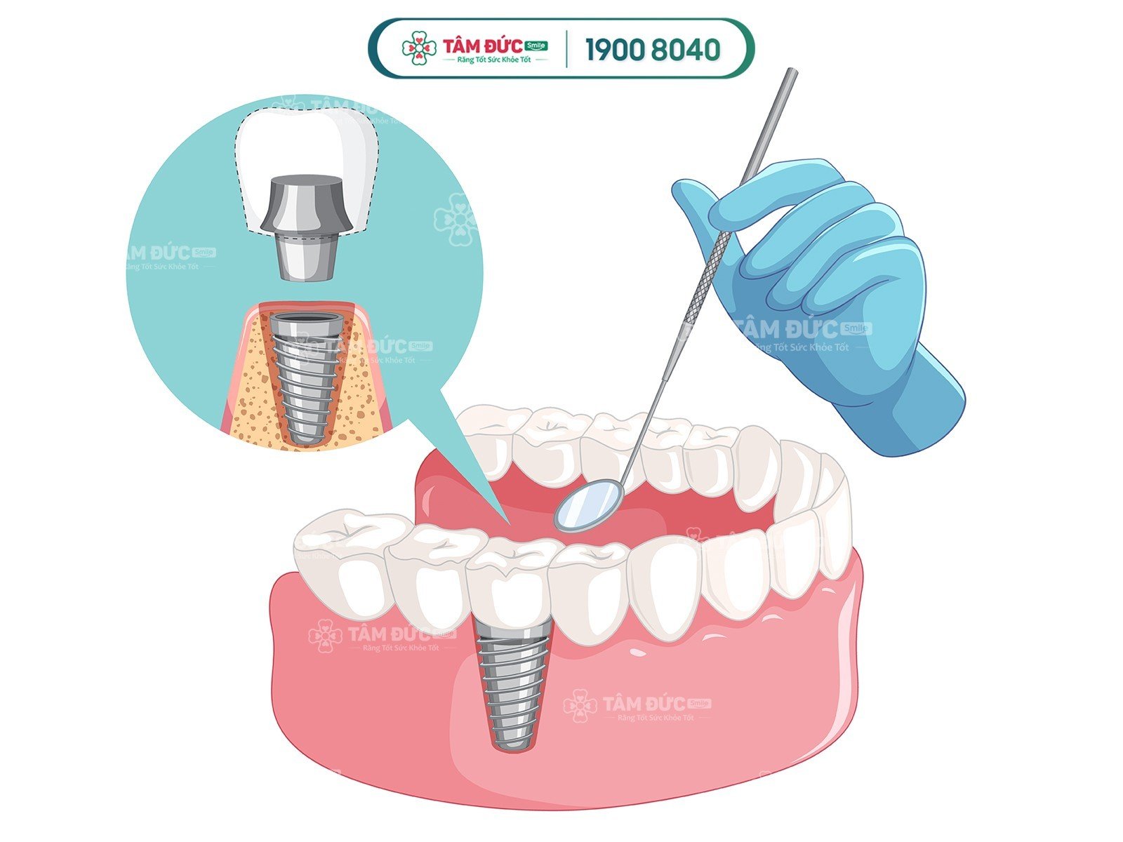 TRỒNG RĂNG IMPLANT HÀN QUỐC GIÁ BAO NHIÊU TIỀN?