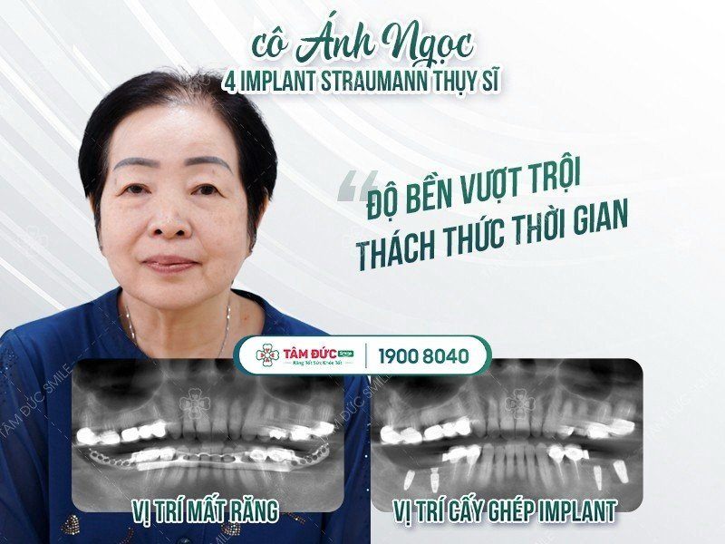TRÔNG RĂNG VỚI TRỤ IMPLANT THUỴ SĨ UNIVERSE CÓ TỐT KHÔNG?