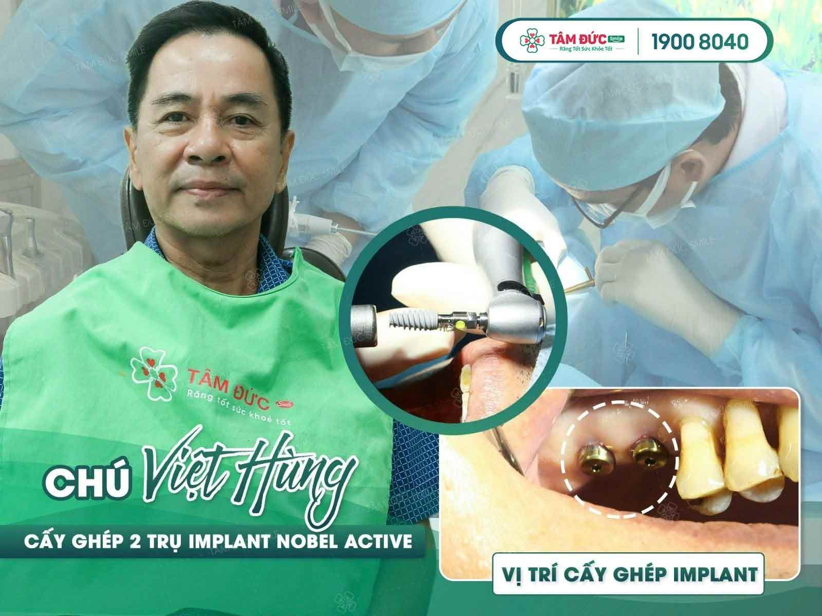 trụ implant nobel active
