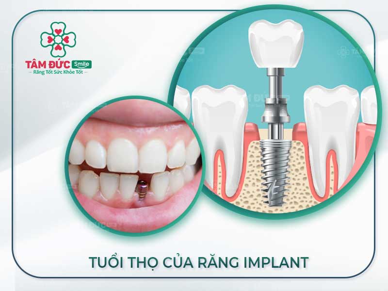 TUỔI THỌ RĂNG IMPLANT BAO LÂU? VÌ SAO NÊN TRỒNG RĂNG IMPLANT