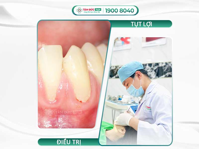 TỤT LỢI CHÂN RĂNG PHẢI LÀM SAO?