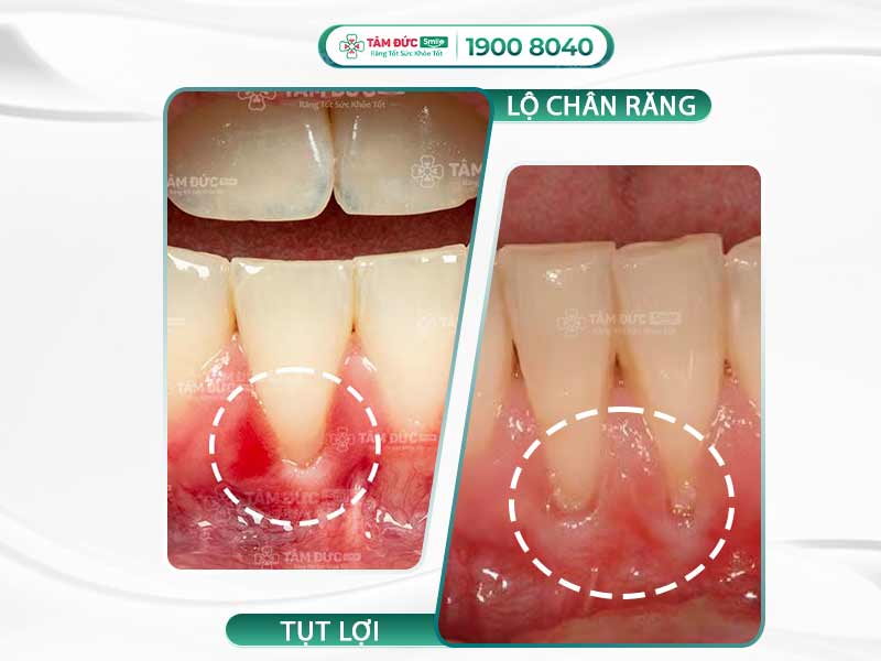TỤT LỢI CÓ TỰ KHỎI ĐƯỢC KHÔNG? MẸO ĐIỀU TRỊ TỤT LỢI HIỆU QUẢ VÀ AN TOÀN