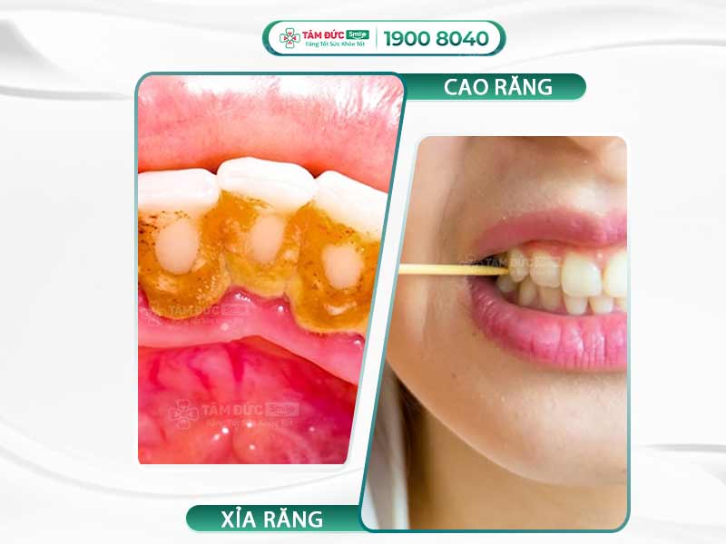 TỤT LỢI HỞ CHÂN RĂNG LÀ NHƯ THẾ NÀO? NGUYÊN NHÂN LÀ GÌ? CHỮA TRỊ CÓ KHÓ KHÔNG?