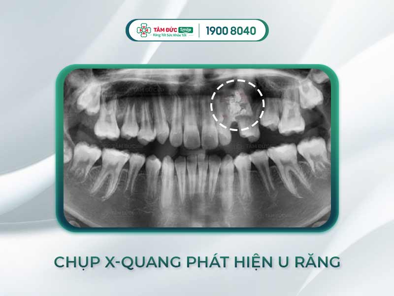 U RĂNG LÀ GÌ? U RĂNG NGUY HIỂM KHÔNG VÀ CÁCH ĐIỀU TRỊ U RĂNG HIỆU QUẢ