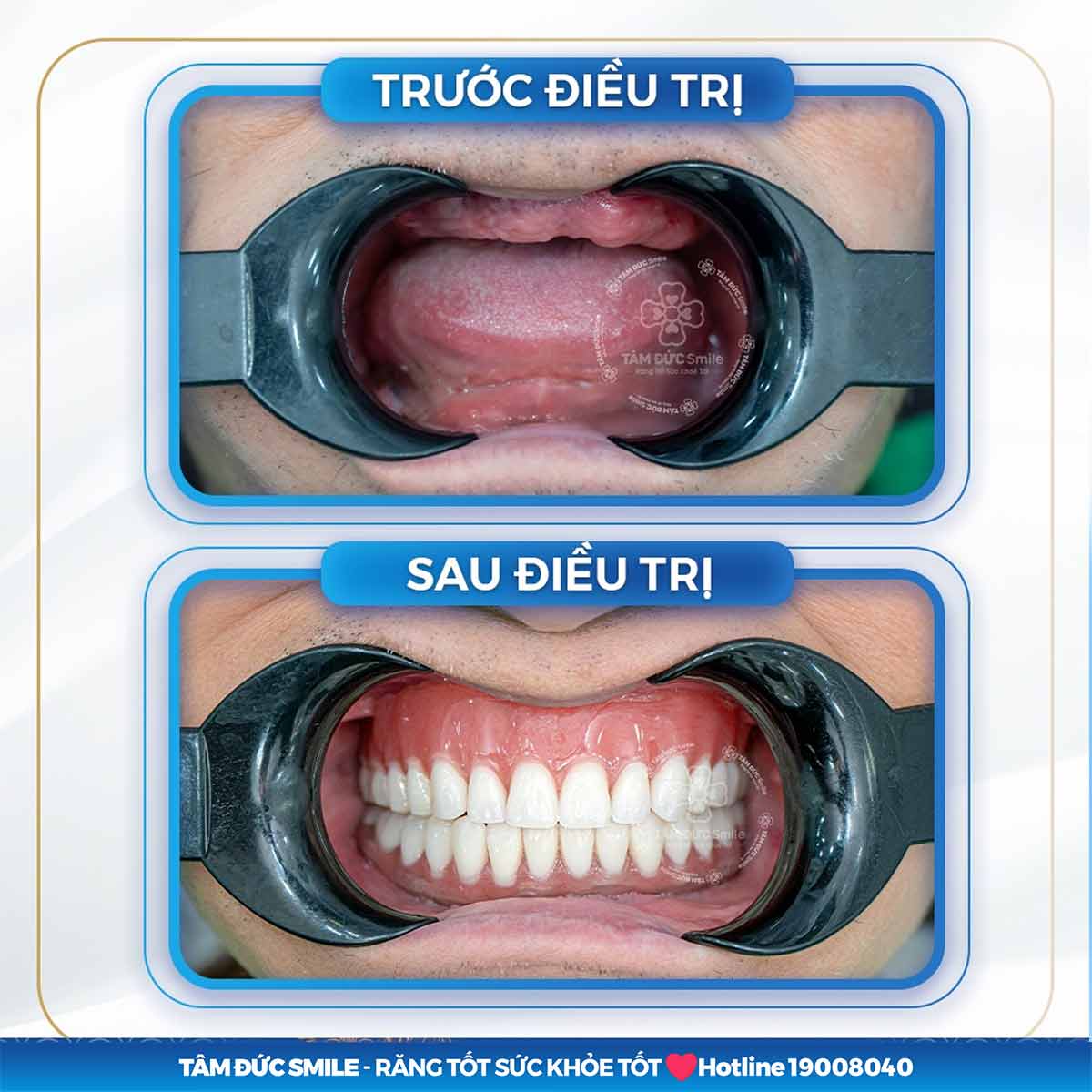 ƯU NHƯỢC ĐIỂM CỦA CÁC PHƯƠNG PHÁP LÀM RĂNG GIẢ NGUYÊN HÀM