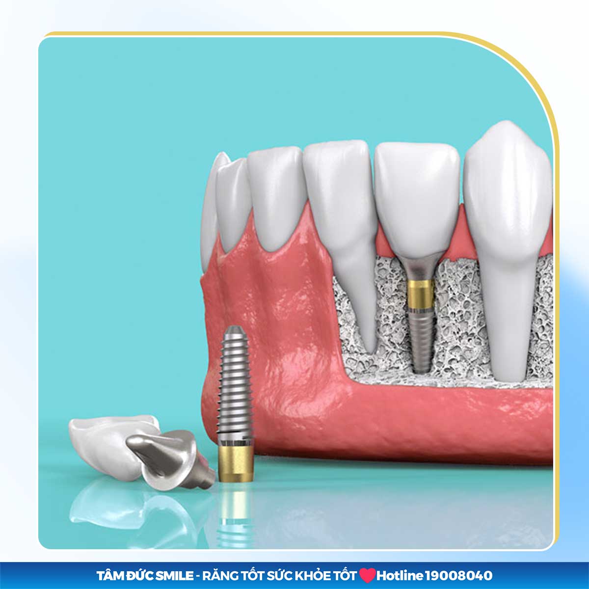 ALL ON 4 LÀ GÌ? ƯU NHƯỢC ĐIỂM CỦA CẤY GHÉP IMPLANT TOÀN HÀM