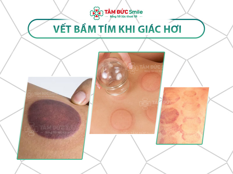 VẾT BẦM TÍM KHI GIÁC HƠI VÌ SAO MÀ CÓ? PHẢI CHĂNG LÀ ĐỘC TỐ TRONG CƠ THỂ?