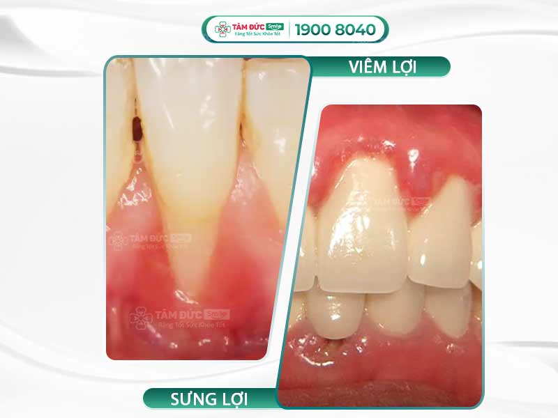 VIÊM LỢI LÀ GÌ? NGUYÊN NHÂN, ẢNH HƯỞNG VÀ CÁCH ĐIỀU TRỊ VIÊM LỢI 