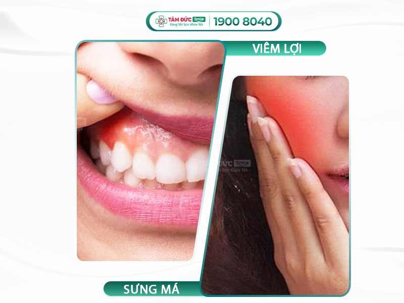 VIÊM LỢI SƯNG MÁ: NGUYÊN NHÂN VÀ CÁCH ĐIỀU TRỊ AN TOÀN, HIỆU QUẢ