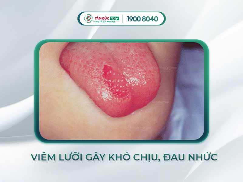 VIÊM LƯỠI LÀ GÌ? TRIỆU CHỨNG KHI BỊ VIÊM LƯỠI SẼ NHƯ THẾ NÀO?