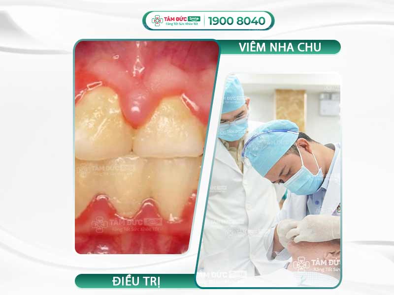 VIÊM NHA CHU LÀ BỆNH GÌ? CÁCH ĐIỀU TRỊ VIÊM NƯỚU NHA CHU HIỆU QUẢ