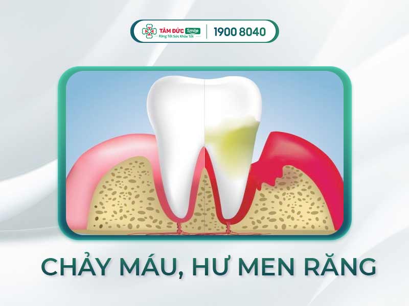  XỈA RĂNG BỊ CHẢY MÁU CÓ SAO KHÔNG? BIỆN PHÁP LÀM SẠCH RĂNG THAY THẾ TĂM XỈA BẰNG TRE