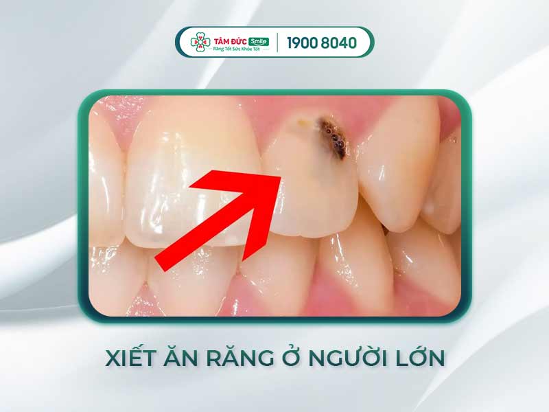 XIẾT ĂN RĂNG Ở NGƯỜI LỚN: NGUYÊN NHÂN, TRIỆU CHỨNG VÀ CÁCH ĐIỀU TRỊ