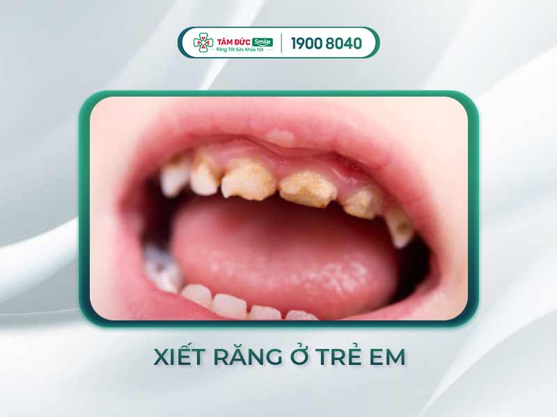 XIẾT ĂN RĂNG Ở TRẺ EM LÀ DO ĐÂU? LÀM SAO ĐỂ KHẮC PHỤC TRIỆT ĐỂ?