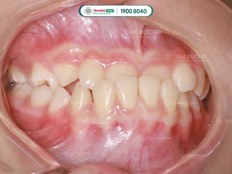 xương hàm dưới đưa ra có sao không